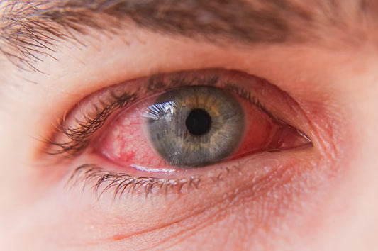 All About Pink Eye: Recognising and Treating the Condition