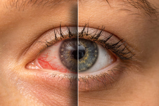 Introduction to Red Eyes: Causes, Symptoms, and Potential Risks
